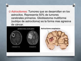 O Astrocitomas: Tumores que se desarrollan en los
astrocitos. Representa 50% de tumores
cerebrales primarios. Glioblastoma multiforme
(subtipo de astrocitoma) es la forma mas agresiva
de cáncer.
 
