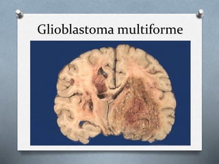 Glioblastoma multiforme
 
