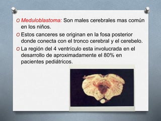 O Meduloblastoma: Son males cerebrales mas común
en los niños.
O Estos canceres se originan en la fosa posterior
donde conecta con el tronco cerebral y el cerebelo.
O La región del 4 ventrículo esta involucrada en el
desarrollo de aproximadamente el 80% en
pacientes pediátricos.
 