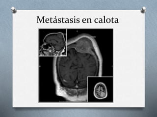 Metástasis en calota
 