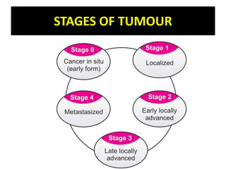 STAGES OF TUMOUR
 