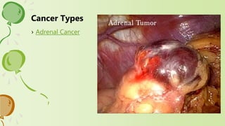 › Adrenal Cancer
Cancer Types
 