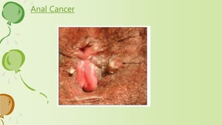 Anal Cancer
 