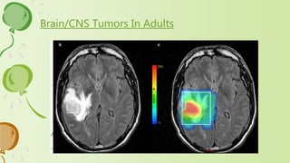 Brain/CNS Tumors In Adults
 