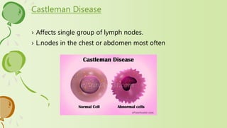 › Affects single group of lymph nodes.
› L.nodes in the chest or abdomen most often
Castleman Disease
 