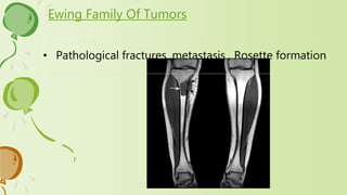 Ewing Family Of Tumors
• Pathological fractures ,metastasis , Rosette formation
 