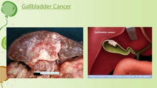 Gallbladder Cancer
 