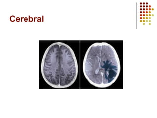 Cerebral
 