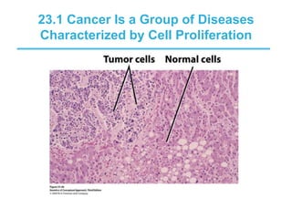 23.1 Cancer Is a Group of Diseases
Characterized by Cell Proliferation
 