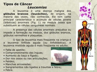 Tipos de Câncer
Leucemias
A leucemia é uma doença maligna dos
glóbulos brancos (leucócitos), de origem, na
maioria das vezes, não conhecida. Ela tem como
principal característica o acúmulo de células jovens
(blásticas) anormais (Fig. 1) na medula óssea que
substituem as células sanguíneas normais.
A presença das células anormais prejudica ou
impede a formação na medula, dos glóbulos brancos,
glóbulos vermelhos e plaquetas.
O tipo de leucemia mais freqüente na criança é
a leucemia linfóide aguda (ou linfoblástica). A
leucemia mielóide aguda é mais freqüente no adulto.
• Falta de apetite;
• Comprometimento das ínguas;
• Aumento do baço e fígado;
• Dor nos ossos ou nas articulações;
• Palidez;
• Manchas arroxeadas;
• Sangramentos não ligados a traumas e febre;
• Febre.
 
