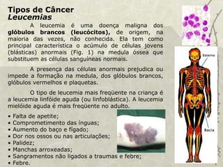 Tipos de Câncer
Leucemias
A leucemia é uma doença maligna dos
glóbulos brancos (leucócitos), de origem, na
maioria das vezes, não conhecida. Ela tem como
principal característica o acúmulo de células jovens
(blásticas) anormais (Fig. 1) na medula óssea que
substituem as células sanguíneas normais.
A presença das células anormais prejudica ou
impede a formação na medula, dos glóbulos brancos,
glóbulos vermelhos e plaquetas.
O tipo de leucemia mais freqüente na criança é
a leucemia linfóide aguda (ou linfoblástica). A leucemia
mielóide aguda é mais freqüente no adulto.
• Falta de apetite;
• Comprometimento das ínguas;
• Aumento do baço e fígado;
• Dor nos ossos ou nas articulações;
• Palidez;
• Manchas arroxeadas;
• Sangramentos não ligados a traumas e febre;
• Febre.
 