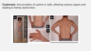 • Cystinosis: Accumulation of cystine in cells, affecting various organs and
leading to kidney dysfunction.
 