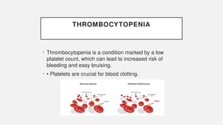 THROMBOCYTOPENIA
• Thrombocytopenia is a condition marked by a low
platelet count, which can lead to increased risk of
bleeding and easy bruising.
• • Platelets are crucial for blood clotting.
 
