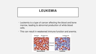 LEUKEMIA
• Leukemia is a type of cancer affecting the blood and bone
marrow, leading to abnormal production of white blood
cells.
• This can result in weakened immune function and anemia.
 