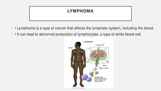 LYMPHOMA
• • Lymphoma is a type of cancer that affects the lymphatic system, including the blood.
• • It can lead to abnormal production of lymphocytes, a type of white blood cell.
 