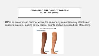 IDIOPATHIC THROMBOCYTOPENIC
PURPURA (ITP):
• ITP is an autoimmune disorder where the immune system mistakenly attacks and
destroys platelets, leading to low platelet counts and an increased risk of bleeding.
 
