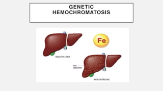 GENETIC
HEMOCHROMATOSIS
 