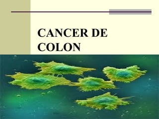 CANCER DE
COLON
 