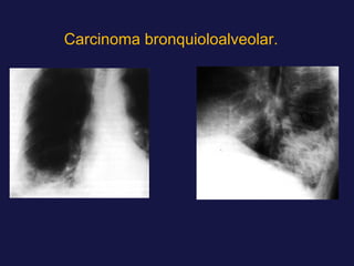 Carcinoma bronquioloalveolar. 