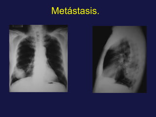Metástasis. 