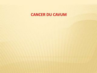 CANCER DU CAVUM
 