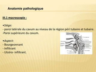 Anatomie pathologique
III.1 macroscopie :
•Siège:
- paroi latérale du cavum au niveau de la région péri tubaire et tubaire.
-Paroi supérieure du cavum.
•Aspect:
- Bourgeonnant
- Infiltrant
- Ulcéro- infiltrant.
 