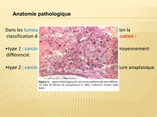 Dans les tumeurs épithéliales, on distingue 3 types selon la
classification de l’OMS, basée sur le degré de différenciation :
•type 1 : carcinome épidermoïde kératinisant, bien à moyennement
différencié.
•type 2 : carcinome épidermoïde non kératinisant mature anaplasique.
Anatomie pathologique
 