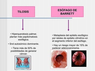 TILOSIS
• Hiperqueratosis palmar,
plantar más papilomatosis
esofágica.
• Snd autosómico dominante.
• Tiene más de 50% de
posibilidades de generar
cáncer.
• Metaplasia del epitelio esofágico
por islotes de epitelio cilíndrico en
el segmento inferior del esófago.
• Hay un riesgo mayor de 15% de
padecer adenocarcinoma.
ESÓFAGO DE
BARRETT
 