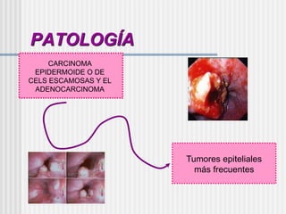 PATOLOGÍA
CARCINOMA
EPIDERMOIDE O DE
CELS ESCAMOSAS Y EL
ADENOCARCINOMA
Tumores epiteliales
más frecuentes
 