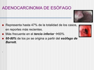 ADENOCARCINOMA DE ESÓFAGO
 Representa hasta 47% de la totalidad de los casos,
en reportes más recientes.
 Más frecuente en el tercio inferior 60%
 60-80% de los px se origina a partir del esófago de
Barrett.
.
 