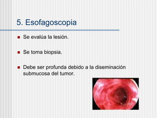 5. Esofagoscopia
 Se evalúa la lesión.
 Se toma biopsia.
 Debe ser profunda debido a la diseminación
submucosa del tumor.
 