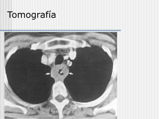 Tomografía
 