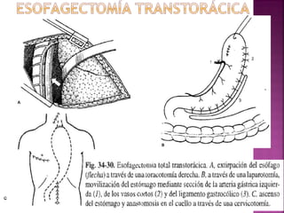 Cancer esofago jose rodriguez