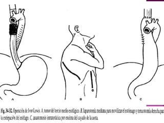 Cancer esofago jose rodriguez