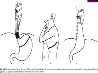 Cancer esofago jose rodriguez