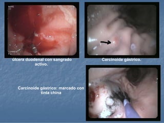 úlcera duodenal con sangrado activo.  Carcinoide gástrico.  Carcinoide gástrico: marcado con tinta china 