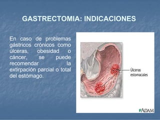 GASTRECTOMIA: INDICACIONES   En caso de problemas gástricos crónicos como úlceras, obesidad o cáncer, se puede recomendar la extirpación parcial o total del estómago.  