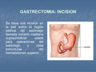 GASTRECTOMIA: INCISION Se hace una incisión en la piel sobre la región pilórica del estómago llamada Incisión mediana supraumbilical usada para operaciones del estómago y otras estructuras del hemiabdomen superior. 