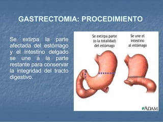 GASTRECTOMIA: PROCEDIMIENTO  Se extirpa la parte afectada del estómago y el intestino delgado se une a la parte restante para conservar la integridad del tracto digestivo.  
