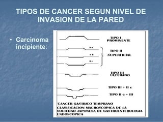 TIPOS DE CANCER SEGUN NIVEL DE INVASION DE LA PARED Carcinoma incipiente : 