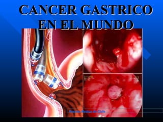 CANCER GASTRICO EN EL MUNDO Revista Medica de Chile 