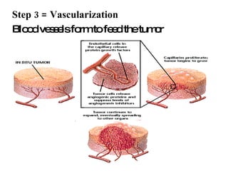Vascularization Step Cancer notes | PPT