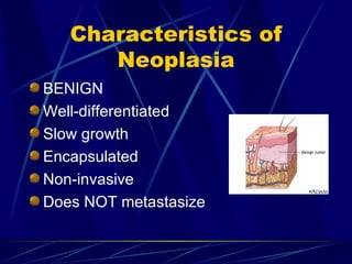 Characteristics of Neoplasia BENIGN Well-differentiated Slow growth Encapsulated  Non-invasive Does NOT metastasize 