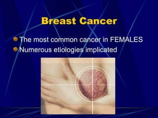 Breast Cancer The most common cancer in FEMALES Numerous etiologies implicated 