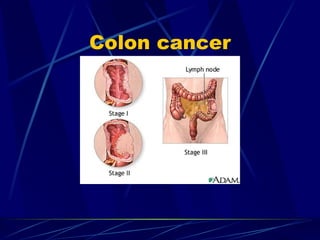 Colon cancer 