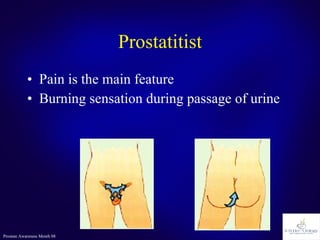 Prostatitist Pain is the main feature Burning sensation during passage of urine 