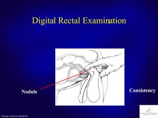 Digital Rectal Examination Nodule Consistency 