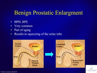 Benign Prostatic Enlargment BPH, BPE Very common Part of aging Results in squeezing of the urine tube 