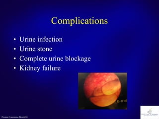 Complications Urine infection Urine stone Complete urine blockage Kidney failure 