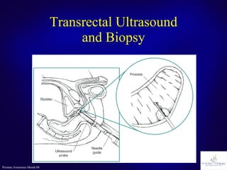 Transrectal Ultrasound and Biopsy 